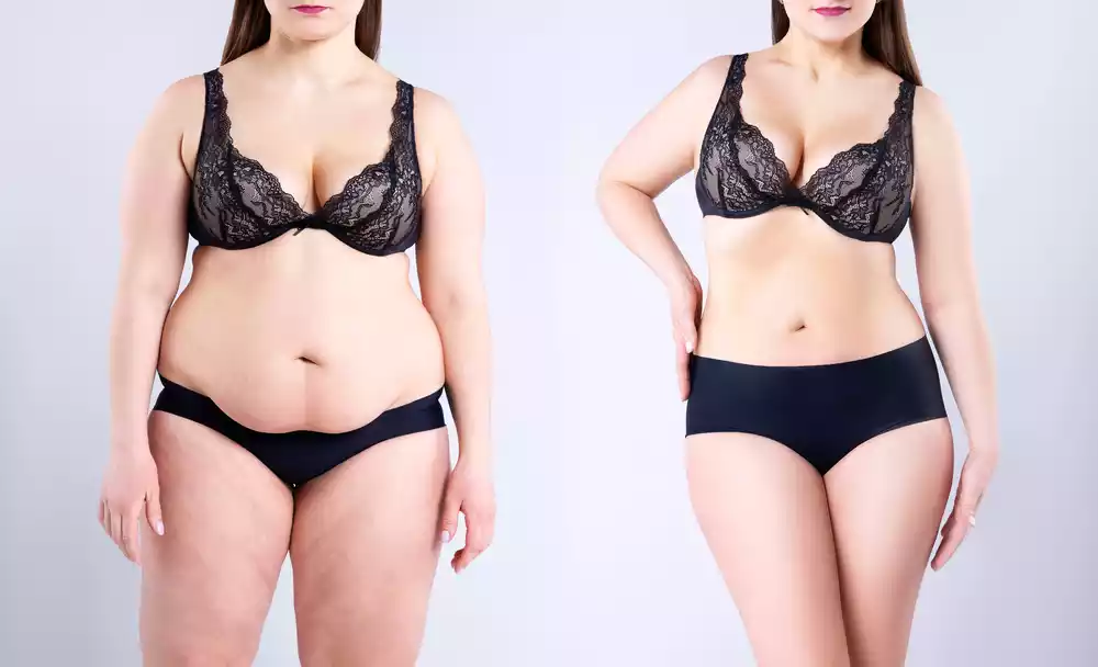 Gastric Sleeve Benefits