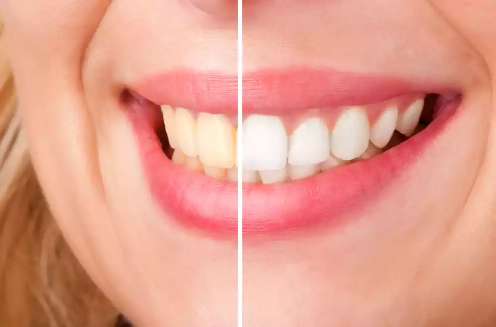 what is whitening