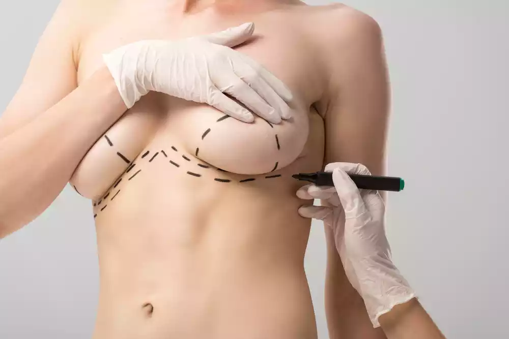 breast surgery (3)