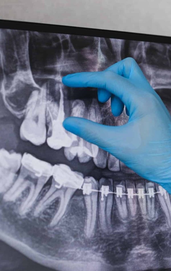 Doctor points to filled root canal in dental x-ray